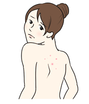 あせもの症状