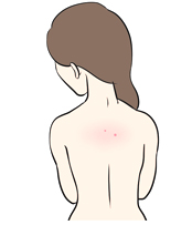 背中ニキビが治らない